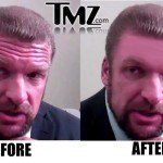 Triple-H forehead
